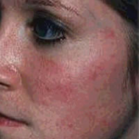 rosacea2.jpg