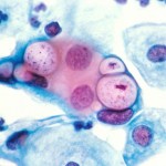 800px-Pap_smear_showing_clamydia_in_the_vacuoles_500x_HE-150x150.jpg